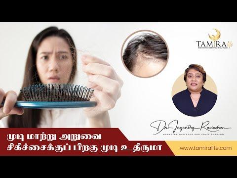 Hair Transplant - Before & After