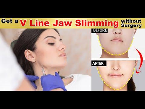 Surgical correction of Masseter - Before & After