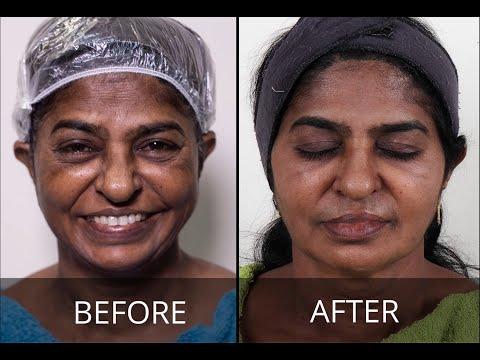 nueromodulator injections (botox) - Before & After