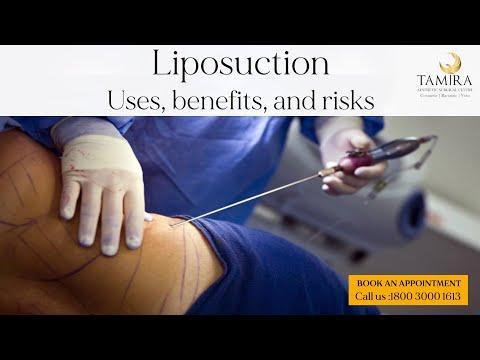 Liposuction - Abdomen - Before & After