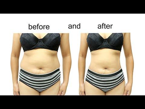 Coolsculpting - Before & After