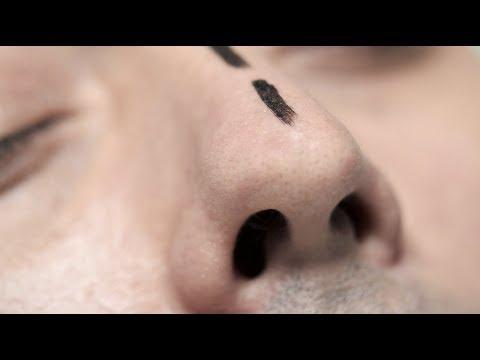 Rhinoplasty - Before & After