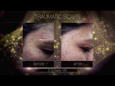 Laser treatment - Hands - Before & After