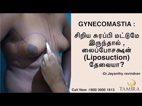 Gynecomastia Surgery - Before & After