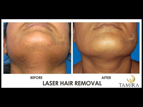 Laser Hair Removal - Before & After