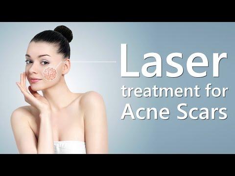 Laser treatment - Skin - Before & After