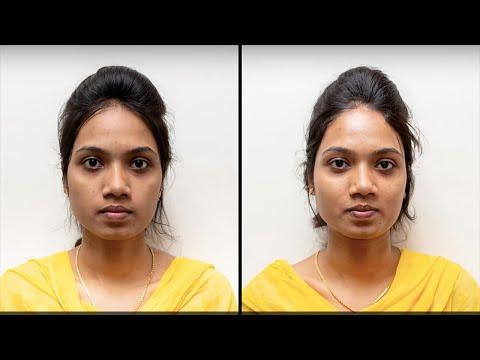 Hydra Facial - Before & After