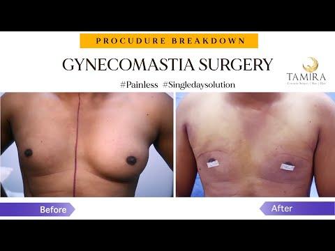 Gynecomastia Surgery - Before & After