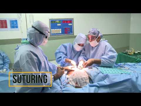 Breast Augmentation with Implants - Before & After