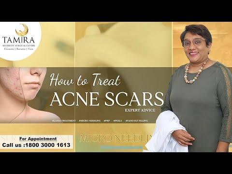 Microneedling - Before & After
