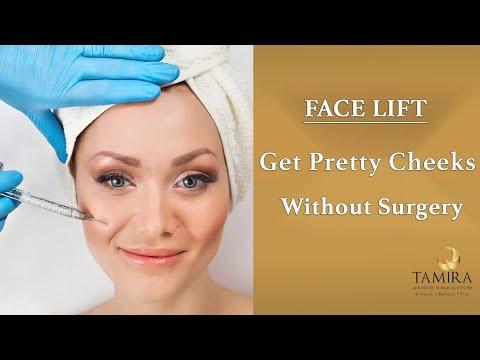 Cheek Augmentation - Before & After