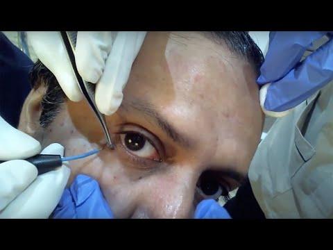 Skin Tag Removal - Before & After
