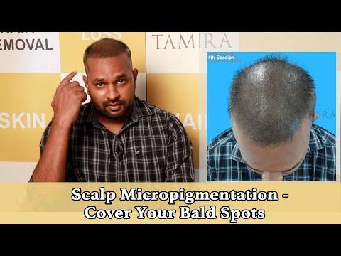 Scalp Micropigmentation - Before & After