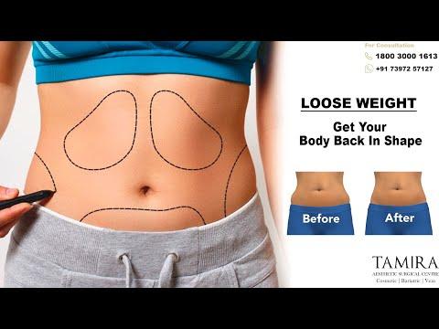Liposuction - Abdomen - Before & After