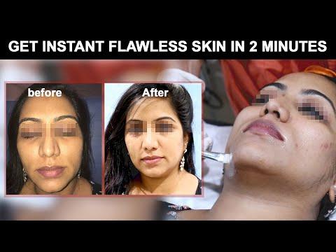 Chemical peels - Arms - Before & After