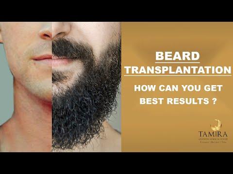 Beard Transplant - Before & After